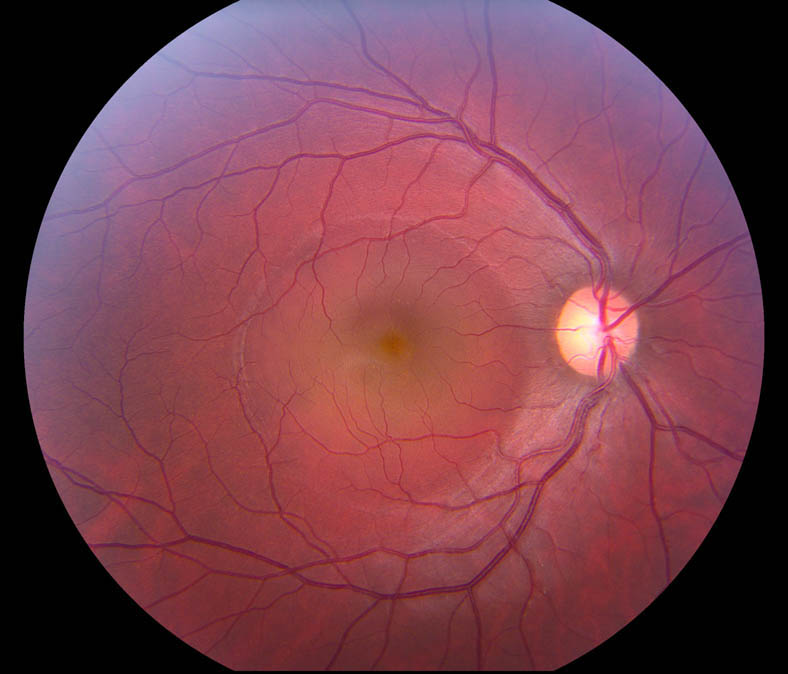 Central Serous Chorioretinopathy - Hình ảnh minh họa